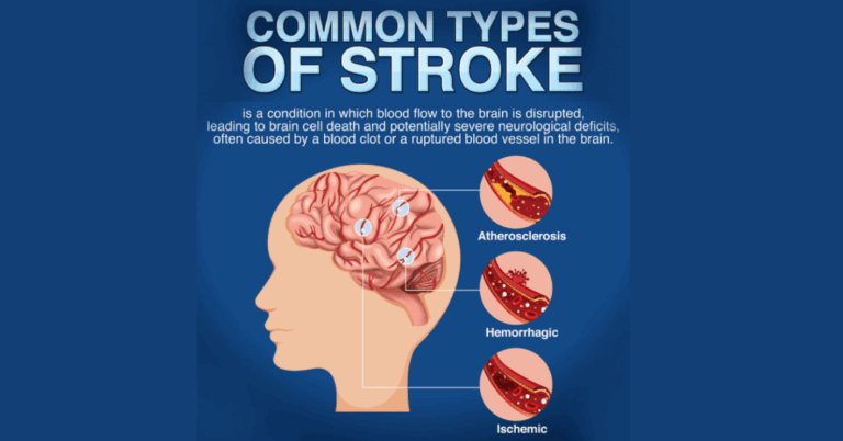Unlocking the Potential of TMS for Stroke Recovery: A Breakthrough in Neurotherapy
